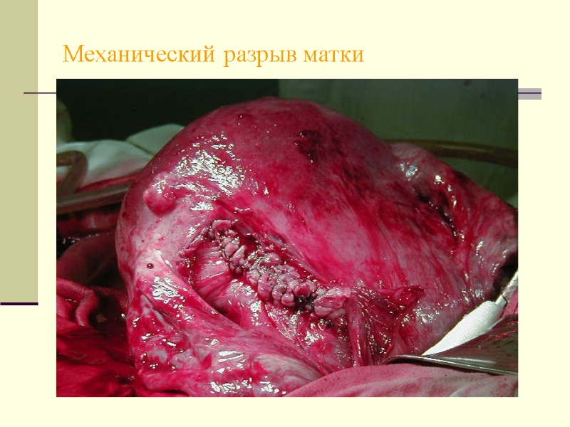 Механический разрыв матки